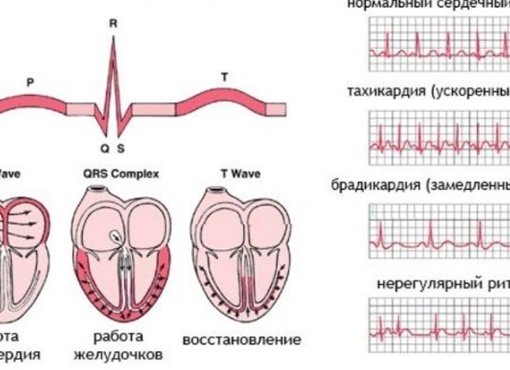 Аритмия. Чем опасно нарушение сердечного ритма