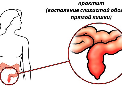 Проктит и его последствия. Почему нельзя тянуть с визитом к врачу