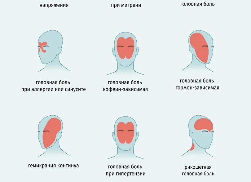 Почему часто болит голова ? —3 причины о которых вы не думали