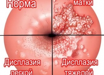 Что такое дисплазия шейки матки и почему важна ранняя диагностика заболевания