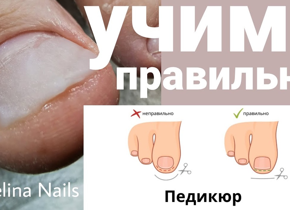 Почему опасно вырезать вросший ноготь дома